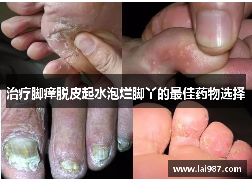 治疗脚痒脱皮起水泡烂脚丫的最佳药物选择